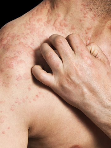 Man Scratching Allergic Skin